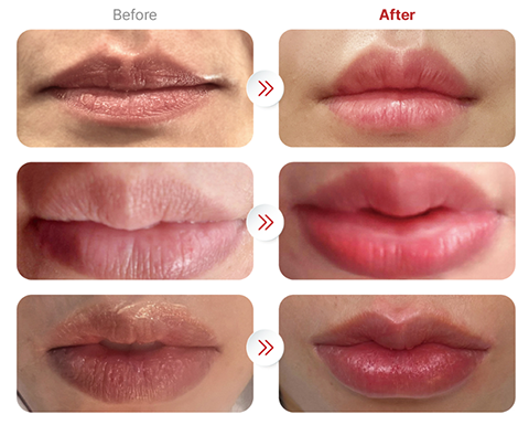 PRIeRE Lip Filler Results